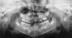 Pediatric Dentist in Manitowoc, WI- Dental Radiographs (X-Rays)