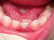 Baby Teeth - Pediatric Dentist in Manitowoc, WI